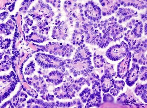CancerRes：新研究發(fā)現(xiàn)幫助清除癌癥干細胞的新靶標