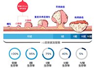 直腸癌早篩試劑盒“第一證”—足不出戶(hù)而明察秋毫