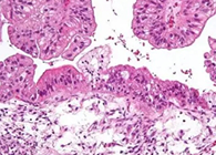 【Science速遞】“沉默的殺手”卵巢癌的治療新靶點(diǎn)終于被發(fā)現(xiàn)了